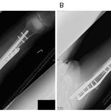 Fond de premiere anaf oug 116/2017. Pdf Salvage Reconstruction With The Masquelet Technique Following Wide Resection For Chondrosarcoma Of The Proximal Femoral Metaphysis A Case Report