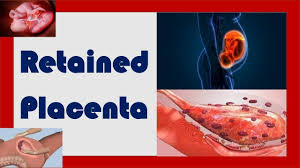 Image result for Retained Placenta
