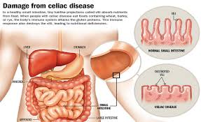 Celiac Disease Swollen Lymph Nodes