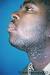 Pseudofolliculitis Nuchae