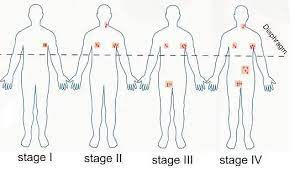 Kan kanserleri, kanın üretildiği yer olan kemik iliğinden kaynaklanan hastanın yaşı, kandaki ldh denilen değerin düzeyi, hastalığın ileri evre olup olmaması, lenf nodu. Lenfoma Olarak Da Bilinen Lenf Kanseri Ile Ilgili En Cok Merak Edilen Sorular Ve Cevaplari Onedio Com
