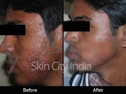 Pin On Skin Care Treatment Skin City India