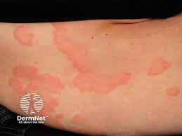 Image result for Exercise-Induced Anaphylaxis