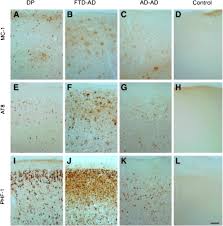 Although the reasons for this are unknown, repeated tbi may cause dp by mechanisms similar to those involved in ad. Chronic Traumatic Encephalopathy Clinical Biomarker Correlations And Current Concepts In Pathogenesis Molecular Neurodegeneration Full Text