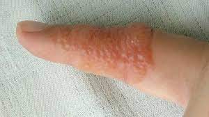Dyshidrotic Eczema Causes Diagnosis Pictures