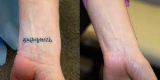 The lincoln tattoo company is the collaborative creation of jason stores and paul friedman. Laser Tattoo Removal Omaha Bellevue Ne Preventative Medical Clinic