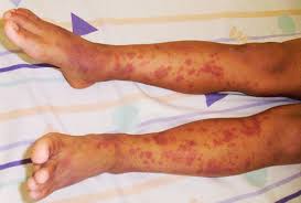 One rash developed after a woman started taking cefazolin, and the other featured the deposition of hemosiderin. Henoch Schonlein Purpura Associated With Bee Sting Case Report Medwave