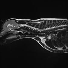 Image result for Syringomyelia