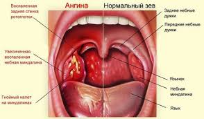 Bol V Gorle Otdaet V Uho Prichiny Simptomy I Lechenie