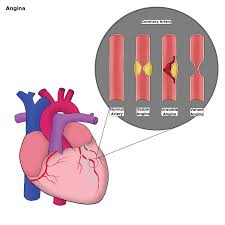 Image result for Unstable Angina