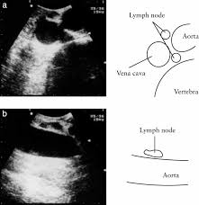 Nodes lying anterior and lateral to the ascending aorta and the aortic arch beneath the upper margin of the aortic arch. Assessment Of Para Aortic Lymph Nodes By Intraoperative Sonography In Gynecological Malignancies A Preliminary Report Ryo 2003 Ultrasound In Obstetrics Amp Gynecology Wiley Online Library