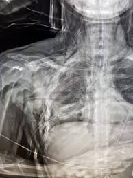 A pneumothorax is a collection of air between the parietal and visceral pleura of the lung. Nadeldekompression Bei Pneumothorax Monaldi Ist Raus News Papers