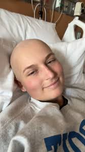 Mackenzie Bald Head with Disease