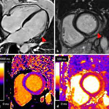 Stellenwert des late gadolinium enhancement im mrt bei myokarditis february 2021 conference: Dietrich Beitzke Medical Doctor Medical University Of Vienna Vienna Meduni Vienna Klinische Abteilung Fur Kardiovaskulare Und Interventionelle Radiologie