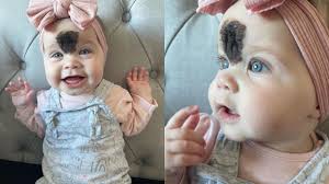 Dziewczynka przyszła na świat z niezwykłym znamieniem. Przeszła operację i  tak wygląda teraz