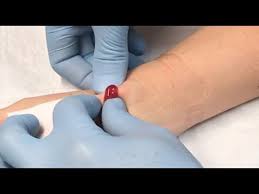 G157g1 (rm) shot of a white caucasian manâ€™s left hand with a broken pinky finger that hasnâ€™t healed properly, and a ganglion cyst lump lodged between the dors Ganglion Cyst Drainage Youtube