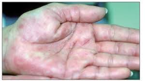 Suspicious Skin Lesions And Secondary Syphilis Patient Care Online