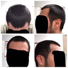 Is My Hairline Receding Or Maturing What Can I Do About This Hair Beauty Skin Deals Me Fashion Love Cute Style Women Mak Hairline Hair Styles Hair