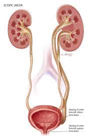 What Is Ectopic Ureter Urology Care Foundation