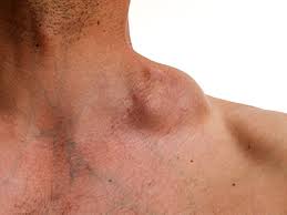 Lymphoma | AproDerm®