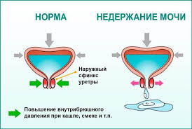 как избавиться от кашля у ребенка в домашних условиях Title S Izobrazheniyami Nederzhanie Mochi U Zhenshin