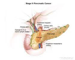 Maybe you would like to learn more about one of these? Pancreatic Cancer Treatment Adult Pdq Patient Version National Cancer Institute