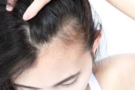 Image result for Alopecia