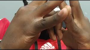 Image result for Elson Extensor Tendon Test