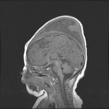 Image result for Vacuum Caput