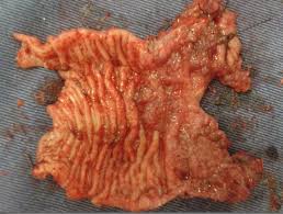 It is a type of cancer. Scielo Brasil Papillary Adenocarcinoma Of The Descending Colon In A Dog Case Report Papillary Adenocarcinoma Of The Descending Colon In A Dog Case Report