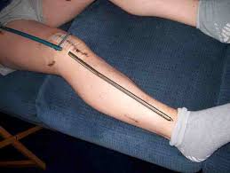 I just got a metal detector. Anyone With Experience With Metal Rods In Them Random Thoughts Hayabusa Owners Group