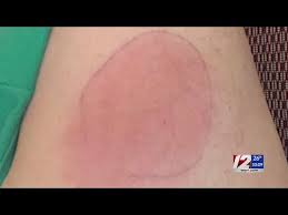 A new study looked at 15 patients who had the rash after getting the first dose and 12 after the second dose. Covid Arm Nothing To Worry About Ridoh Medical Director Says Youtube