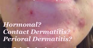 Sometimes, there is no obvious cause for acne. The Acne Whisperer Stubborn Acne Around The Chin And Mouth