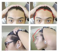 I noticed a hole in my hair especially near my bangs , is it becauz of bangs , because since i was a child i had the same hairstyle (bangs) im 17 btw? I Don T Know What Type Of Hairstyle Suits Me Cause Of My Weird Hairline Styleforum