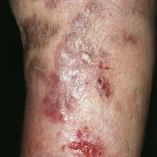 * forma luposa = granuloma es completo. Tuberculosis Cutis Colliquativa Altmeyers Encyclopedia Department Dermatology