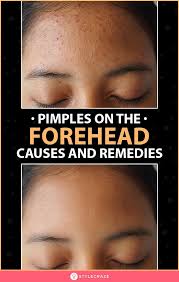 How To Get Rid Of Pimples On Forehead In 2020 Forehead Acne Cause Pimples On Face Pimples On Forehead