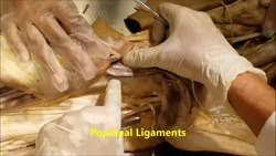 Knee replacement surgery can help you regain your. Popliteus Muscle Wikipedia