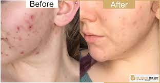 It can also open up your skin to serums and hydration products. Dr Rachi S Skin City Dermaroller Treatment Dermaroller Clinic In Vadodara Dr Rachi S Skin Specialist Doctor At Alkapuri Vadodara Best Dermatological Treatment In Bird Circle Vadodara Dermaroller Specialist In Chakali