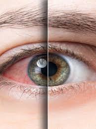 Fadiga Ocular e Olho Seco