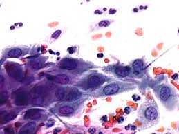 Check spelling or type a new query. Histopathology And Cytopathology Of The Uterine Cervix Digital Atlas Glossary