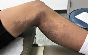 Image result for Atopic Dermatitis