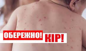Нагадування про кір
