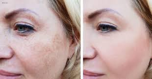 What's the Best Laser Treatment for Hyperpigmentation? – Dr. Kevin  Johnson's Advanced Aesthetics