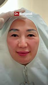 Подбровная блефаропластика в GREEN CLINIC