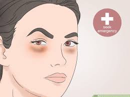 Lazy eye, or amblyopia, is a condition that causes poor vision, usually in one eye.it affects about 3 out of every 100 children. 3 Ways To Get Rid Of Undereye Circles Naturally Wikihow Life
