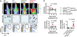 Pleural effusion is excess fluid around the lungs and a common symptom of mesothelioma. Kras Signalling In Malignant Pleural Mesothelioma Biorxiv