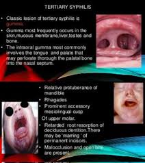 Image result for Tertiary Syphilis