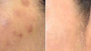 We did not find results for: Pih Post Inflammatory Hyperpigmentation Questions Answered