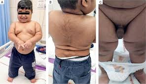 Image result for Precocious Puberty