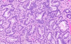 Clinicopathological study of endometrium in iucd users. Pathology Outlines Endometrial Hyperplasia